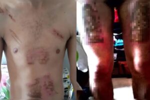 Jovem é torturado, queimado com ferro de passar e chapinha de cabelo pela companheira