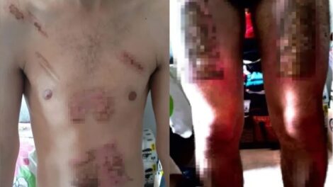 Jovem é torturado, queimado com ferro de passar e chapinha de cabelo pela companheira