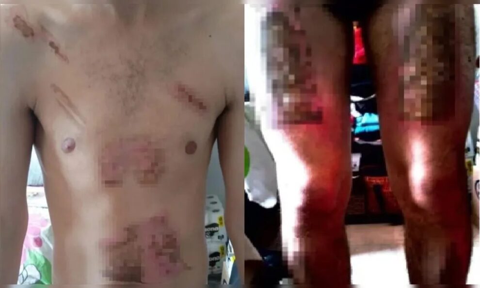 Jovem é torturado, queimado com ferro de passar e chapinha de cabelo pela companheira