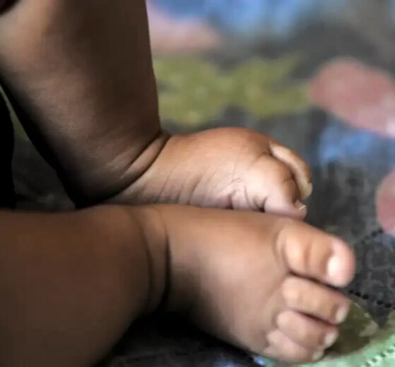 Bebê recém-nascido morre após se engasgar com leite, em Floresta