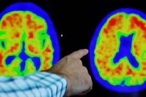 Exame de sangue para Alzheimer chega ao Brasil por R$ 3,2 mil