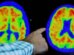 Exame de sangue para Alzheimer chega ao Brasil por R$ 3,2 mil